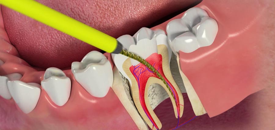 عصب کشی دندان، ضرورت یا انتخاب؟