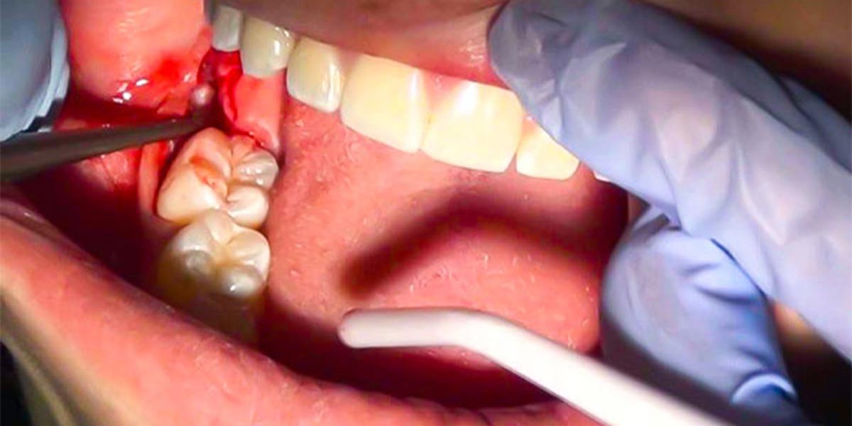 مراقبت های لازم بعد از جراحی دندان