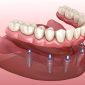 ایمپلنت دندان، راه حلی برای دندان های از دست رفته