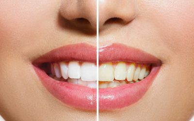 معرفی بهترین روش های سفید کردن دندان