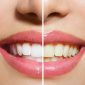 معرفی بهترین روش های سفید کردن دندان